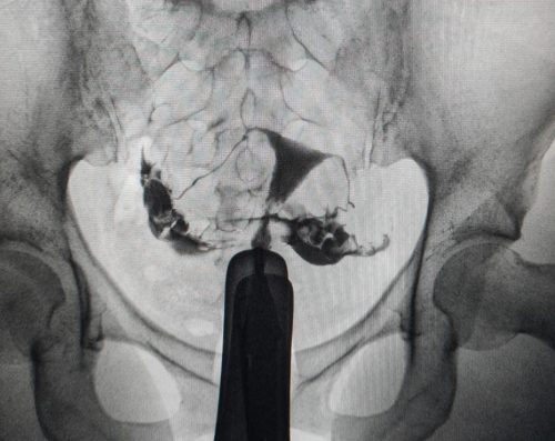 histerosalpingografie hidrosalpinx testarea trompelor